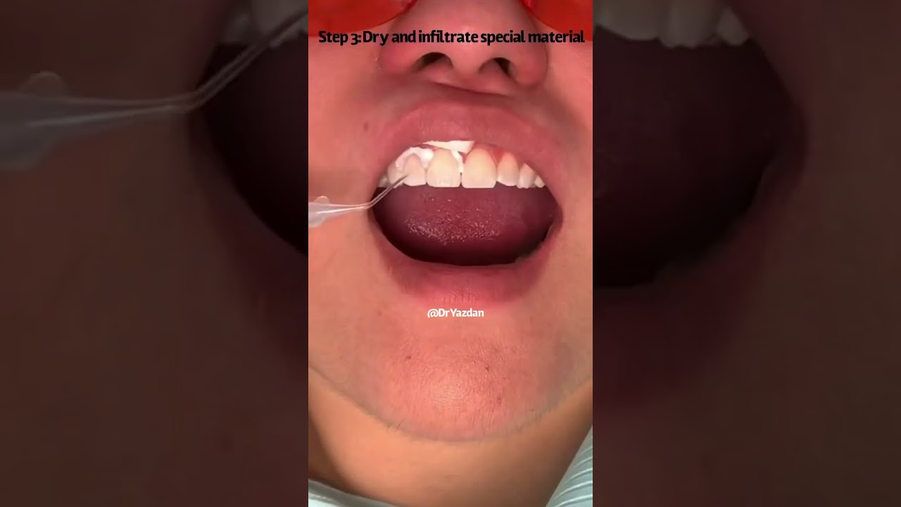 Icon dental treatment white spots lesions | Dr. Yazdan | white spots on teeth | white spot lesion