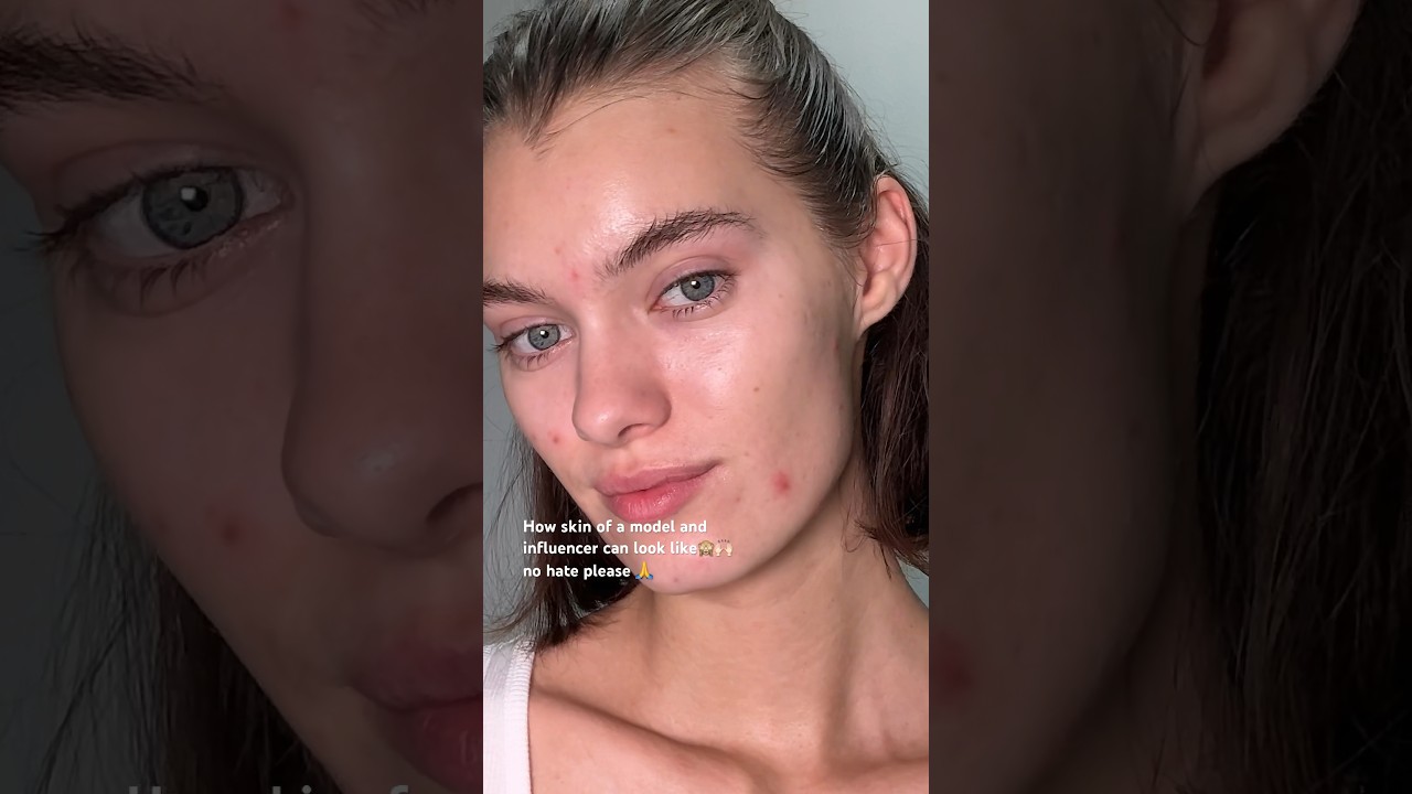 Models also have acne😔🙌🏻#acnetips #acnetreatment #acne #oilyskin #skincare #acneproneskin