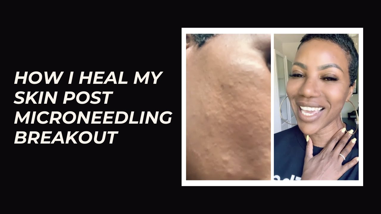 HOW I HEAL MY SKIN POST MICRONEEDLING BREAKOUT