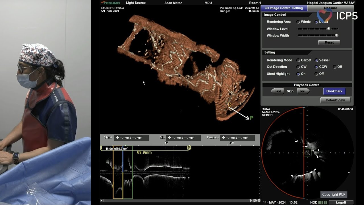 Left main and complex bifurcation stenting - EuroPCR 2024