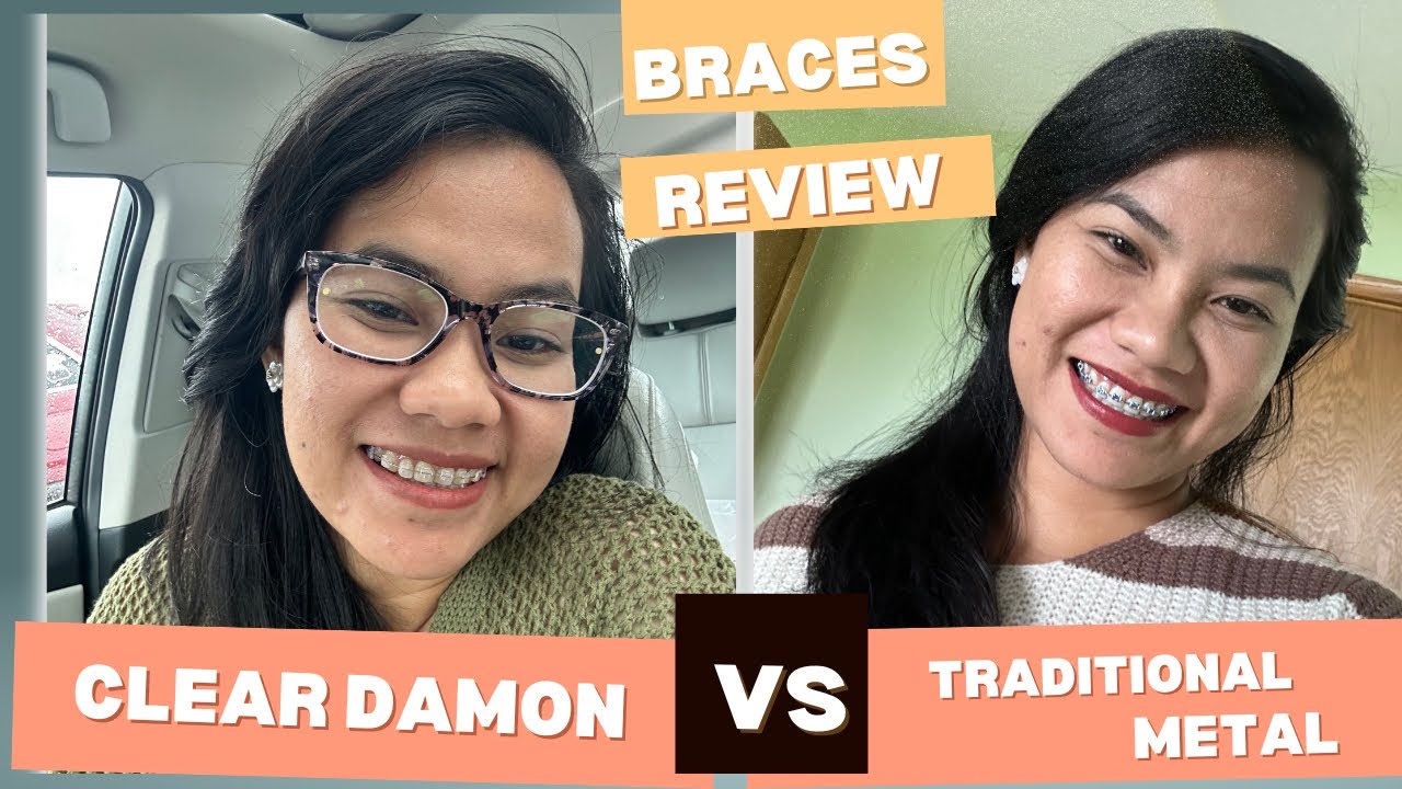 Clear Self ligating braces VS. traditional metal braces. Things I wish I knew before getting damon!