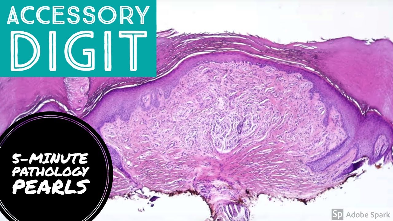 A 6th finger?! Supernumerary (Accessory) Digit: 5-Minute Pathology Pearls