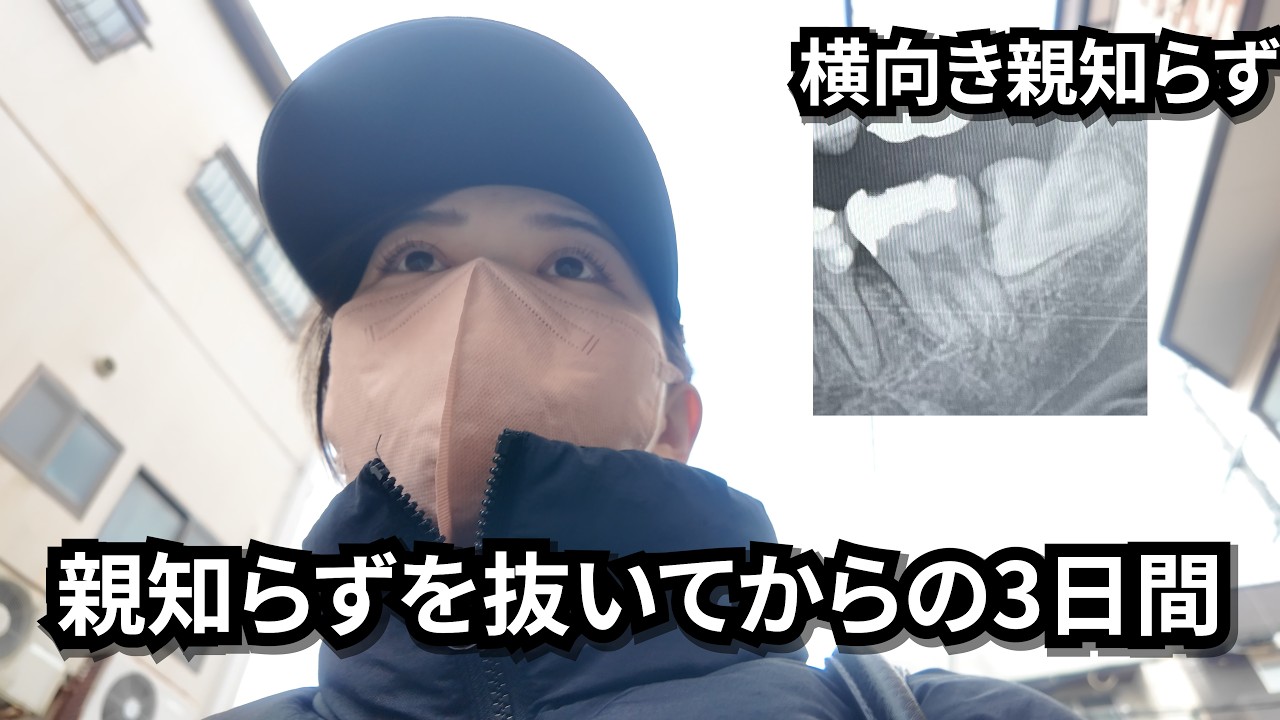 【3日間の経過観察】27歳横向き親知らずを抜きに行く　処置中に起きたレア体験‼️