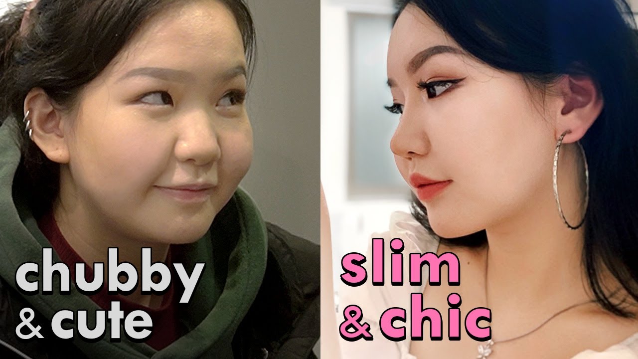[SUB] Nose job & Facial fat surgery VLOG in Korea | Rhinoplasty, Buccal fat removal before and after