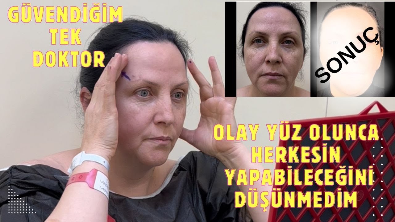 Şakak Germe ve Orta Yüz Germe Ameliyatı Öncesi Sonrası 🌸