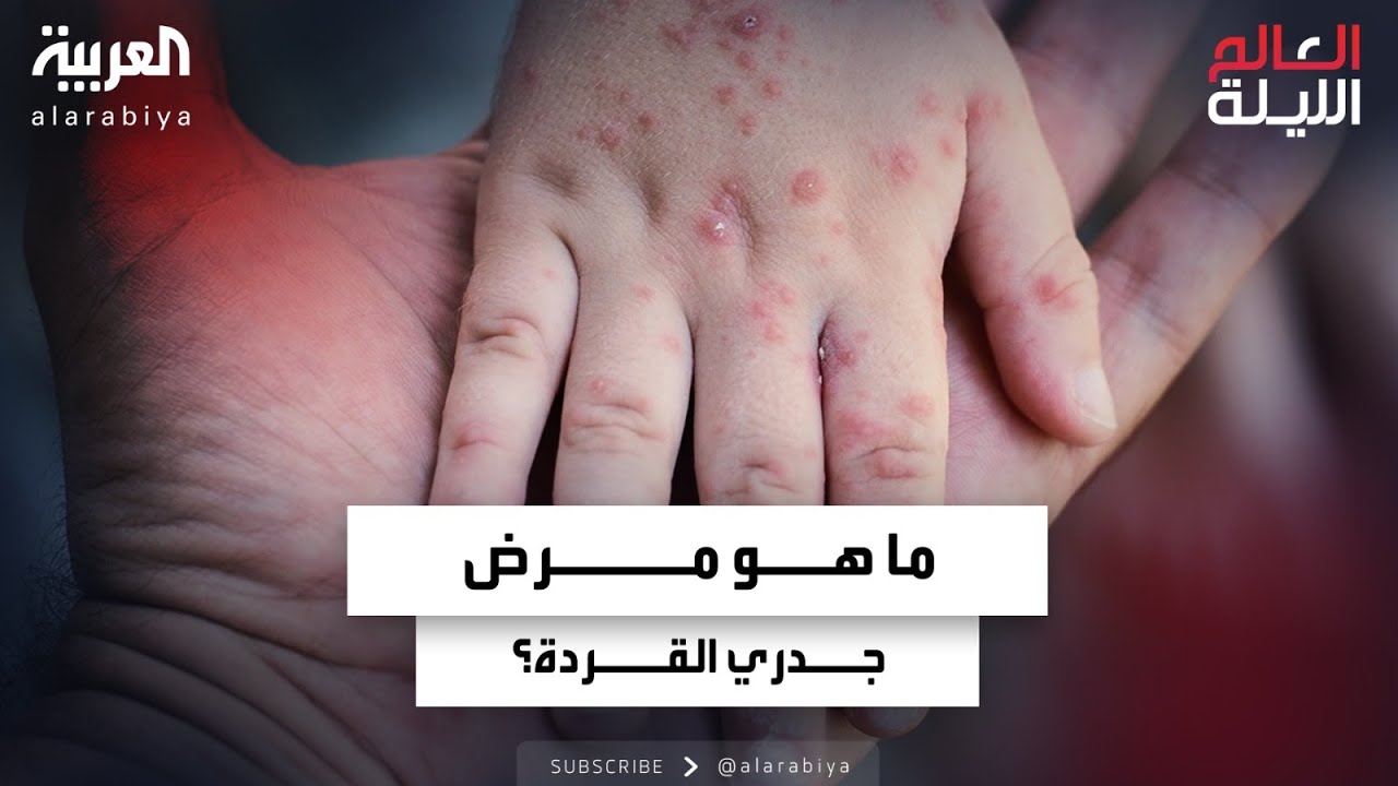 ما هو مرض جدري القردة وما درجة خطورته وطريقة العدوى به؟