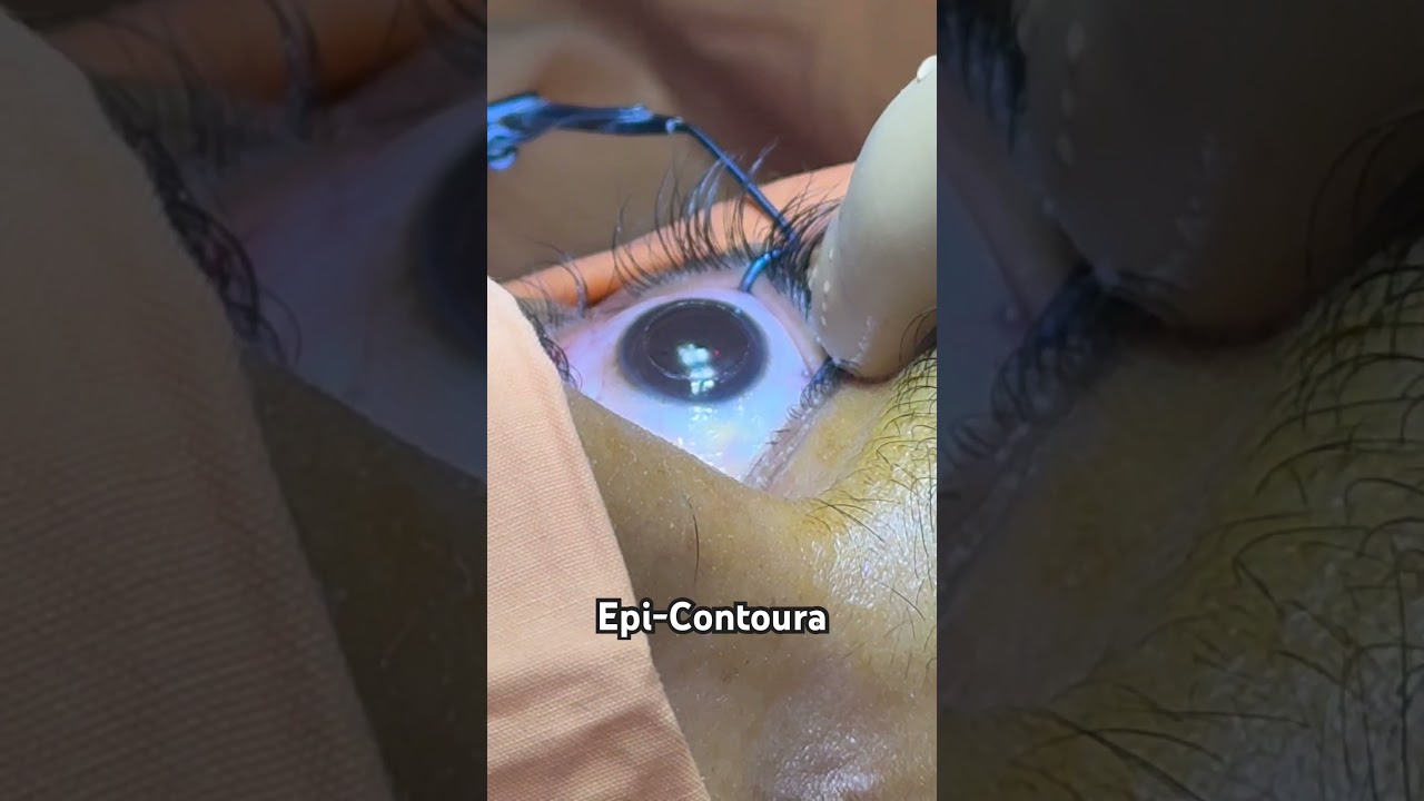 Epi-Contoura #suneyecafe #eyes #refractivesurgery