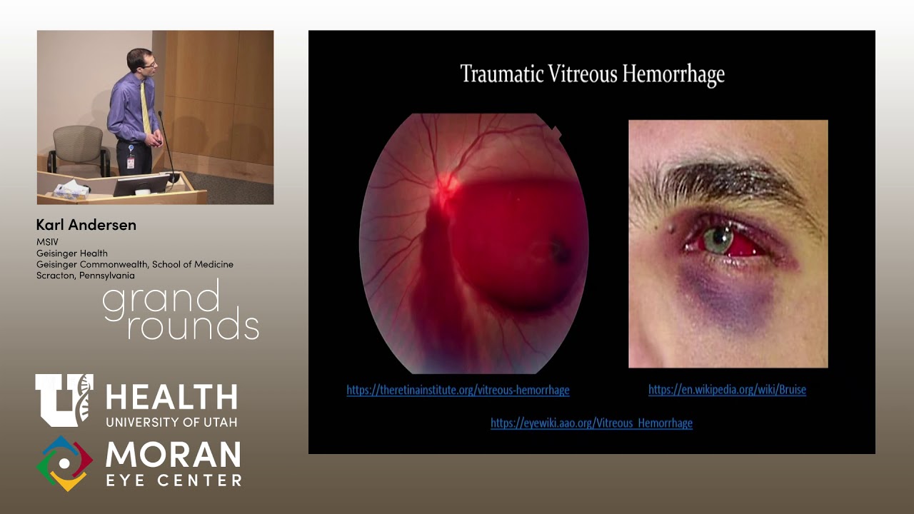 Proliferative Retinopathy in Hemoglobin C Trait