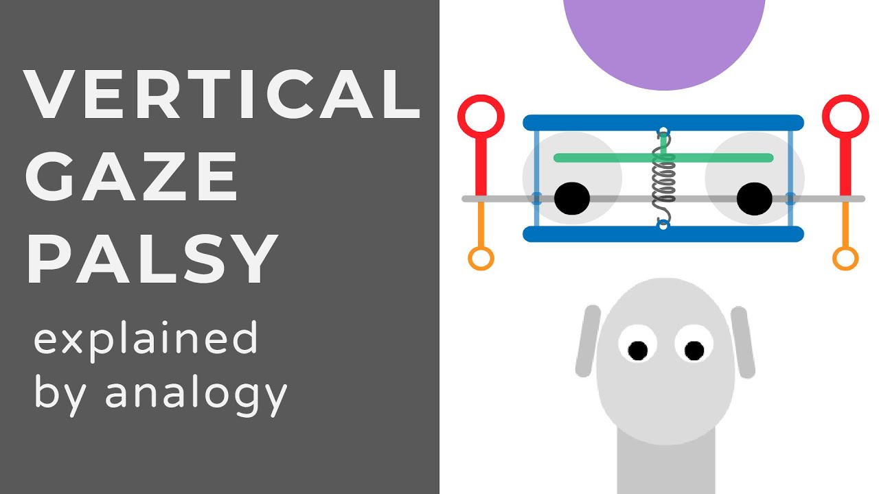 Vertical Gaze Palsy | Progressive Supranuclear Palsy | Dorsal Midbrain Syndrome | Animation
