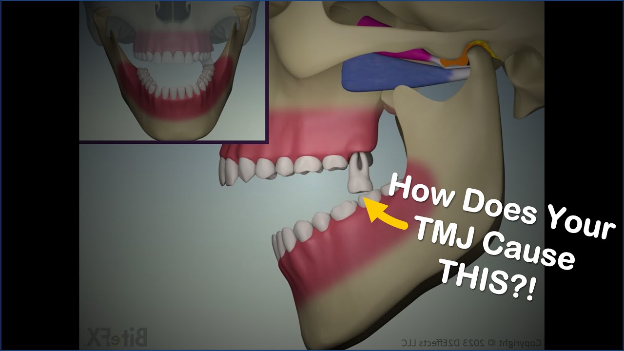 Relating TMJ Issues to Teeth