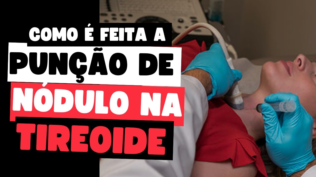 Como &eacute; feita a PAAF: entenda o procedimento e a import&acirc;ncia para diagn&oacute;stico da tireoide