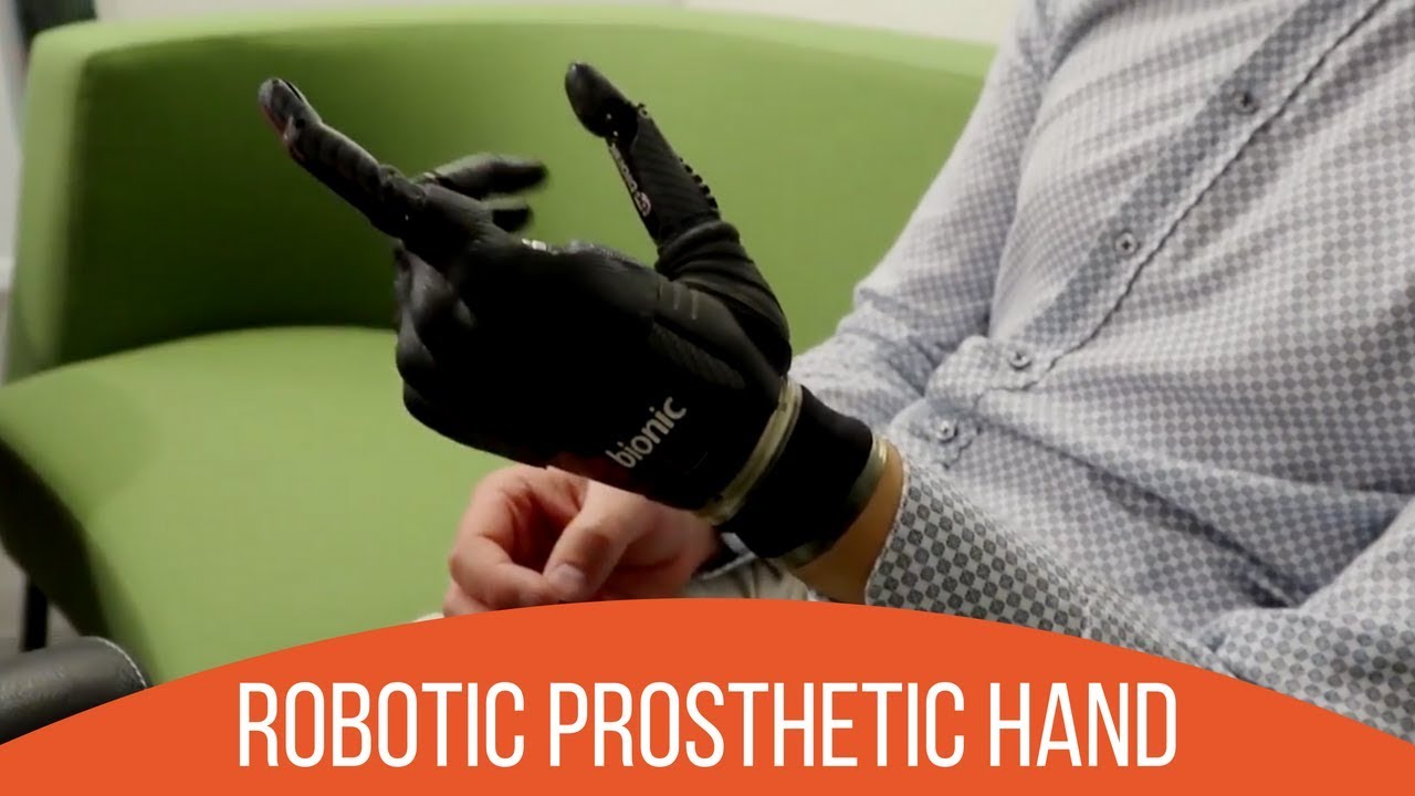 Review of The Bebionic Hand by Triple Amputee