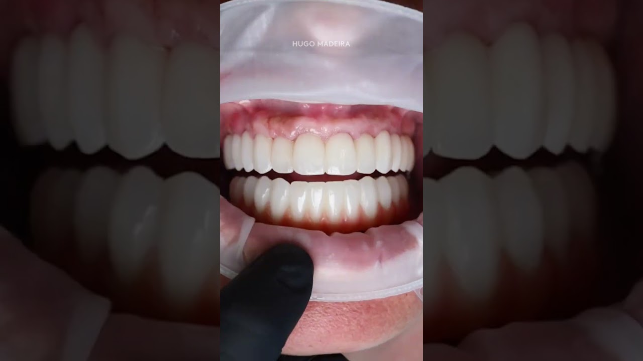 Coloca&ccedil;&atilde;o de ponte sobre implantes 💨