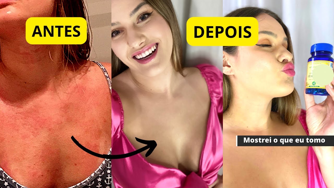 COMO CUREI A DERMATITE ATÓPICA | Atualizado