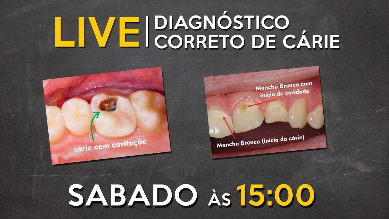 LIVE #066 - Como fazer diagnóstico de cárie