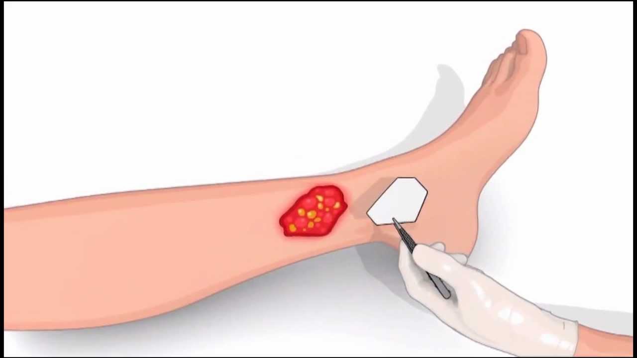 PROMOGRAN PRISMA Matriz para o Equilíbrio de Feridas - Modo de usar