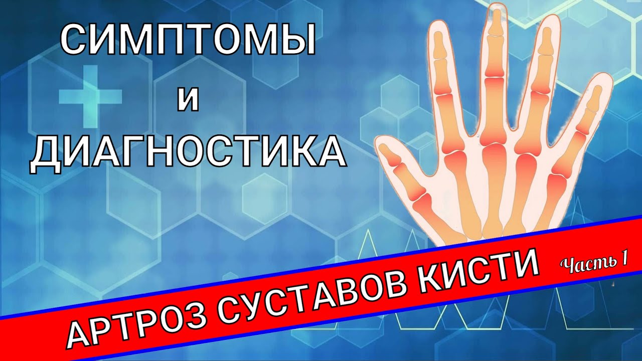 АРТРОЗ СУСТАВОВ КИСТИ (Часть 1)