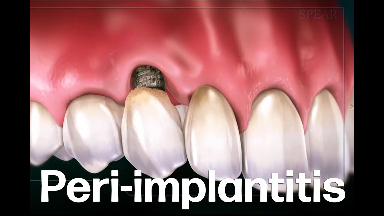 How Lasers Can Help Treat Peri-Implantitis