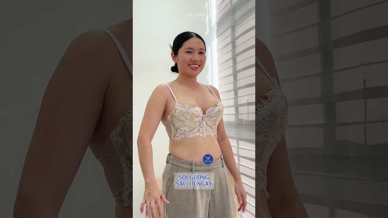 Điều trị V1 sa trễ nặng