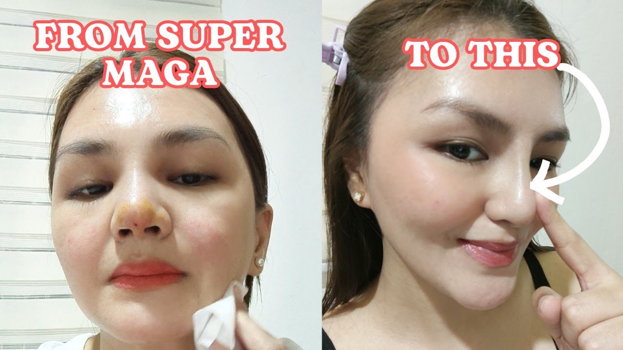 HIKO + BOTOX 2 WEEKS UPDATE &bull; MAGKANO, SAAN, MODE OF PAYMENT, KWENTO!