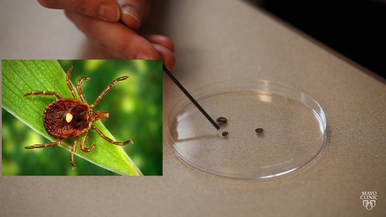 Mayo Clinic Minute: Rise in tick-related meat allergy