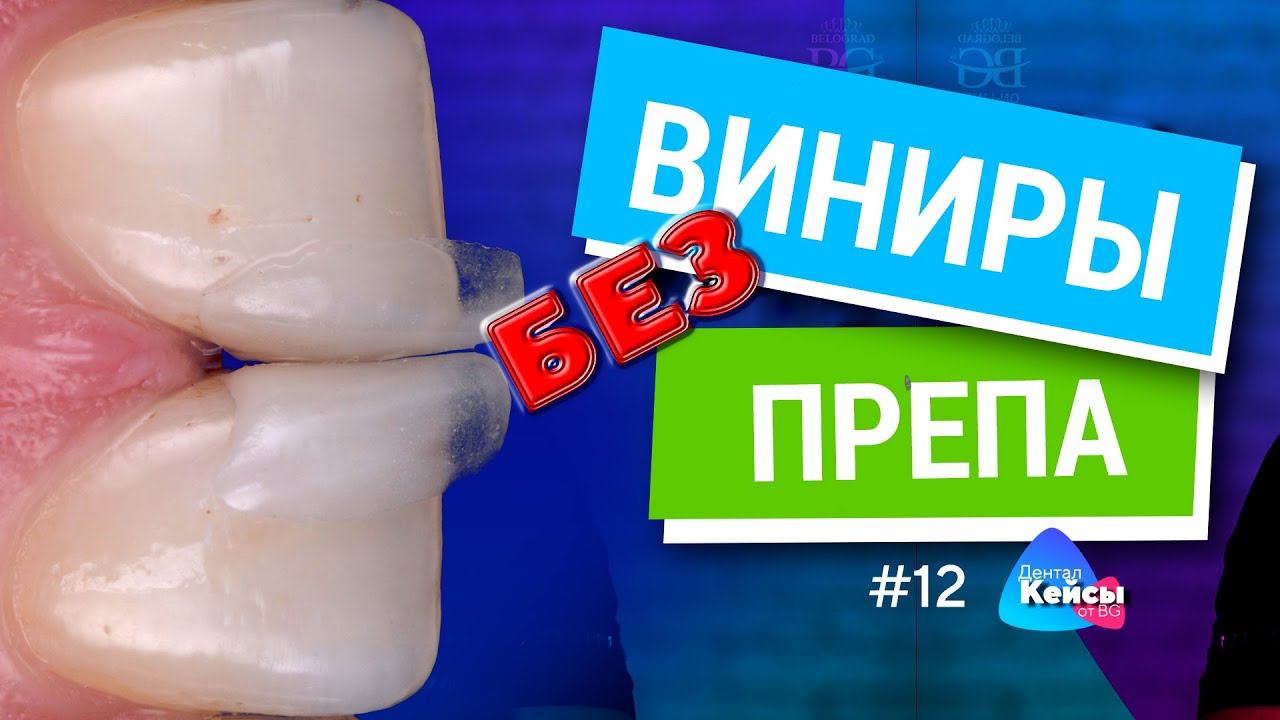 Виниры без препа. Дентал кейсы от BG #12