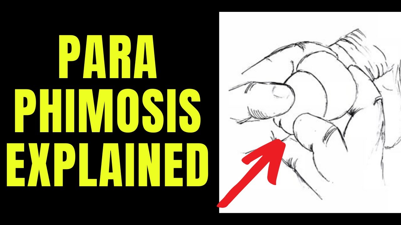 Doctor explains Paraphimosis - aka swollen foreskin that you can't pull back...