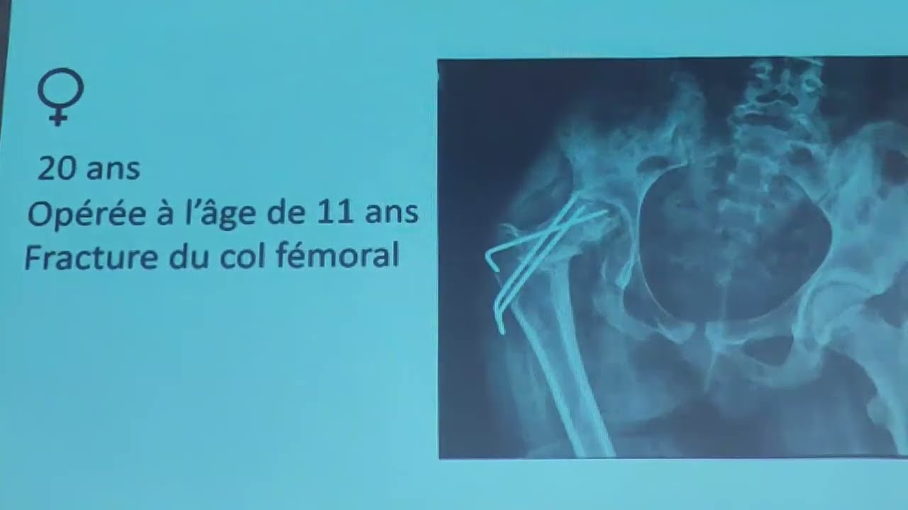PTH DIFFICILE