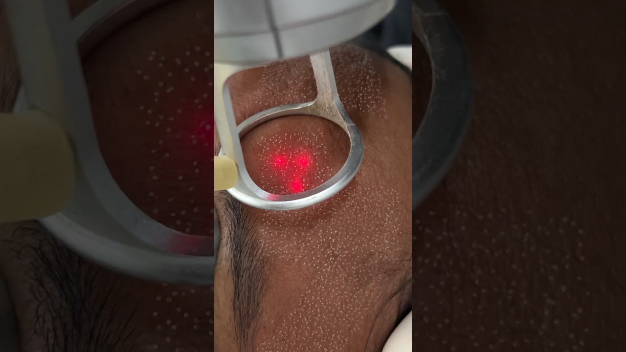 This is how Fractional CO2 laser treatment looks like| laser resurfacing #laserskinrejuvenation