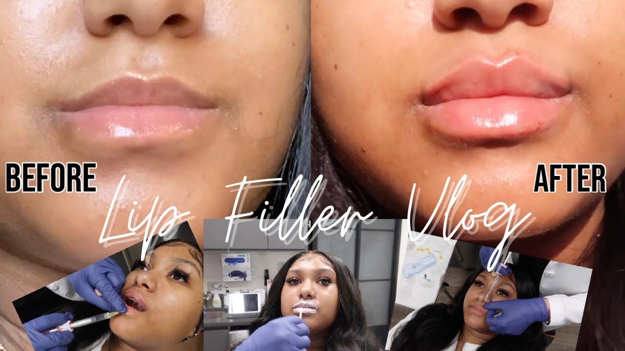 I GOT LIP FILLER/INJECTIONS FOR THE 1ST TIME |New Image Works Chicago *Black Women Get Filler too*