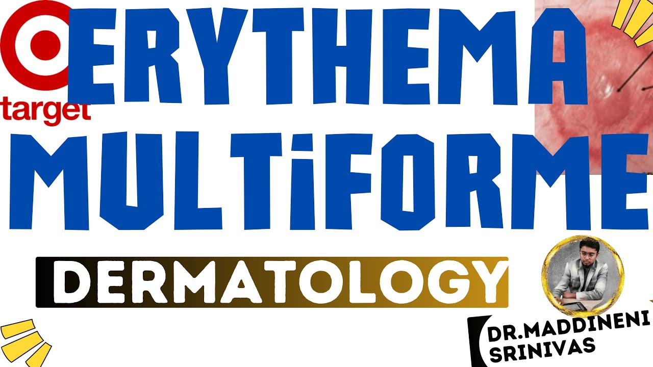 Erythema MultiForme | EMF | Target Lesions | Herpes simplex | Dermatology lectures MBBS | DrMSD |