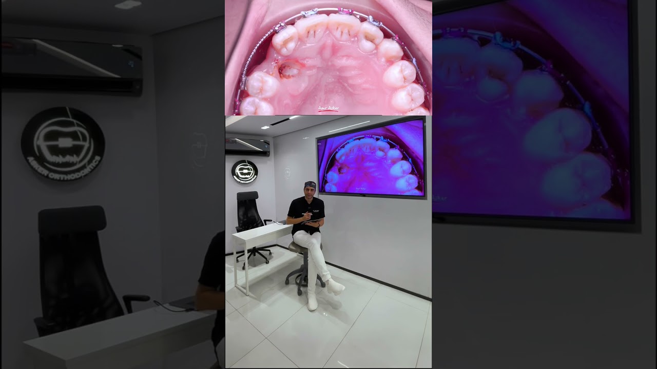 Case series of impacted canine AND  class III
