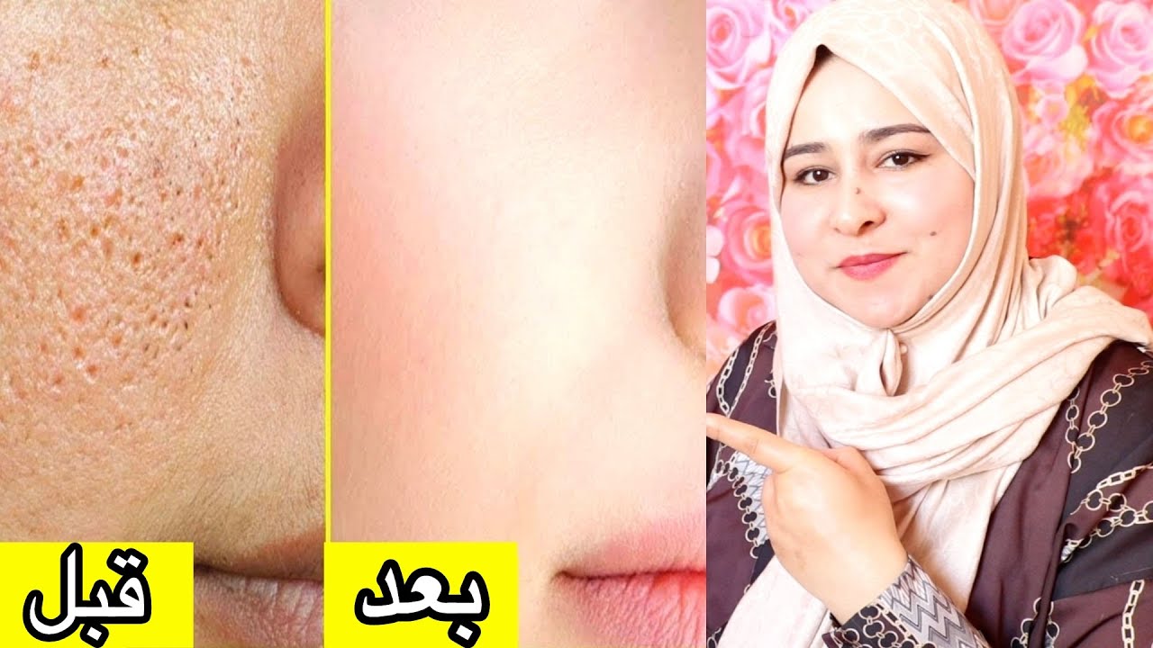 وجهك محفر وفيه مسام مفتوحة؟؟؟؟؟ الحل النهائي بين يدك!!! حل مشاكل البشرة الدهنية.