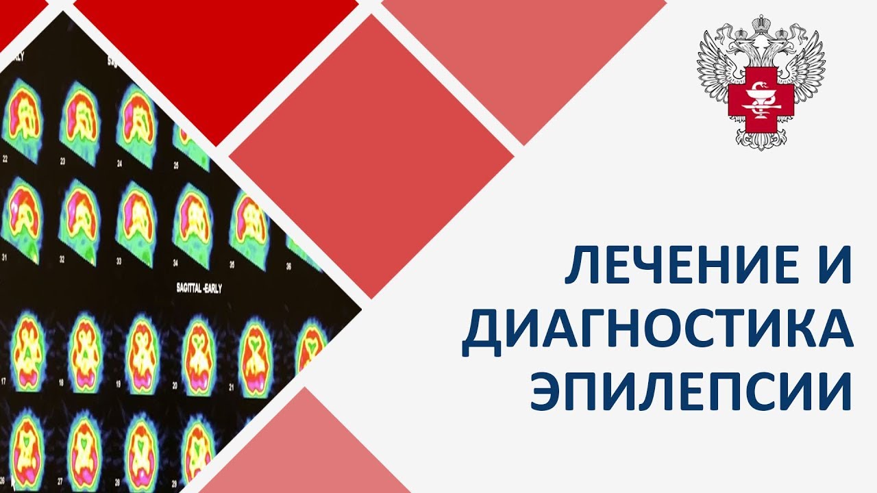 Эпилепсия диагностика лечение. 🧠 Современные методы диагностики и лечения эпилепсии.