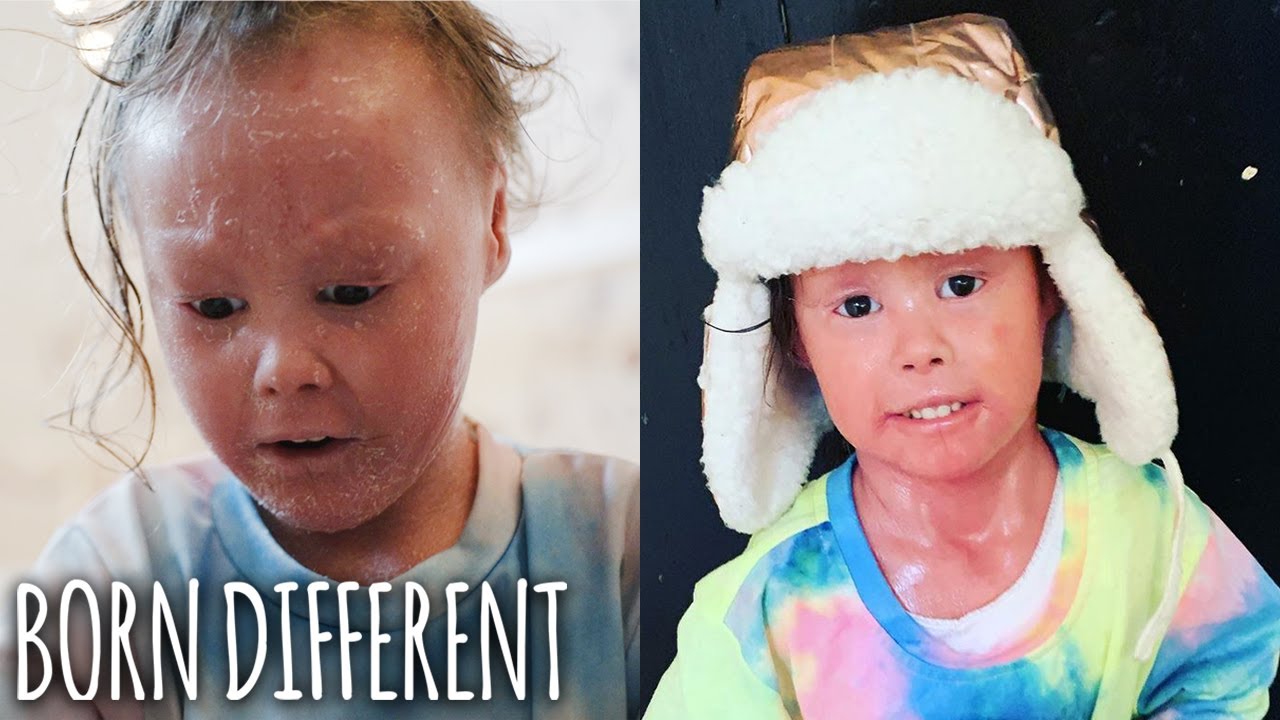 The Girl Whose Skin Grows Too Fast | BORN DIFFERENT