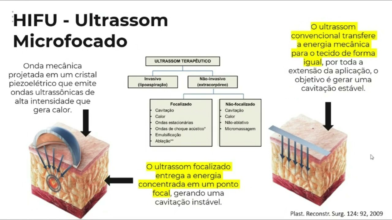 Treinamento Novo Sonofocus
