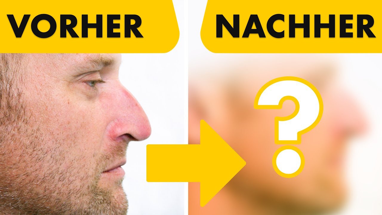 GESCHLOSSENE Nasen-OP: 2 Vorher / Nacher Ergebnisse | Nasenkorrektur beim Mann | Dr. Jungwirth