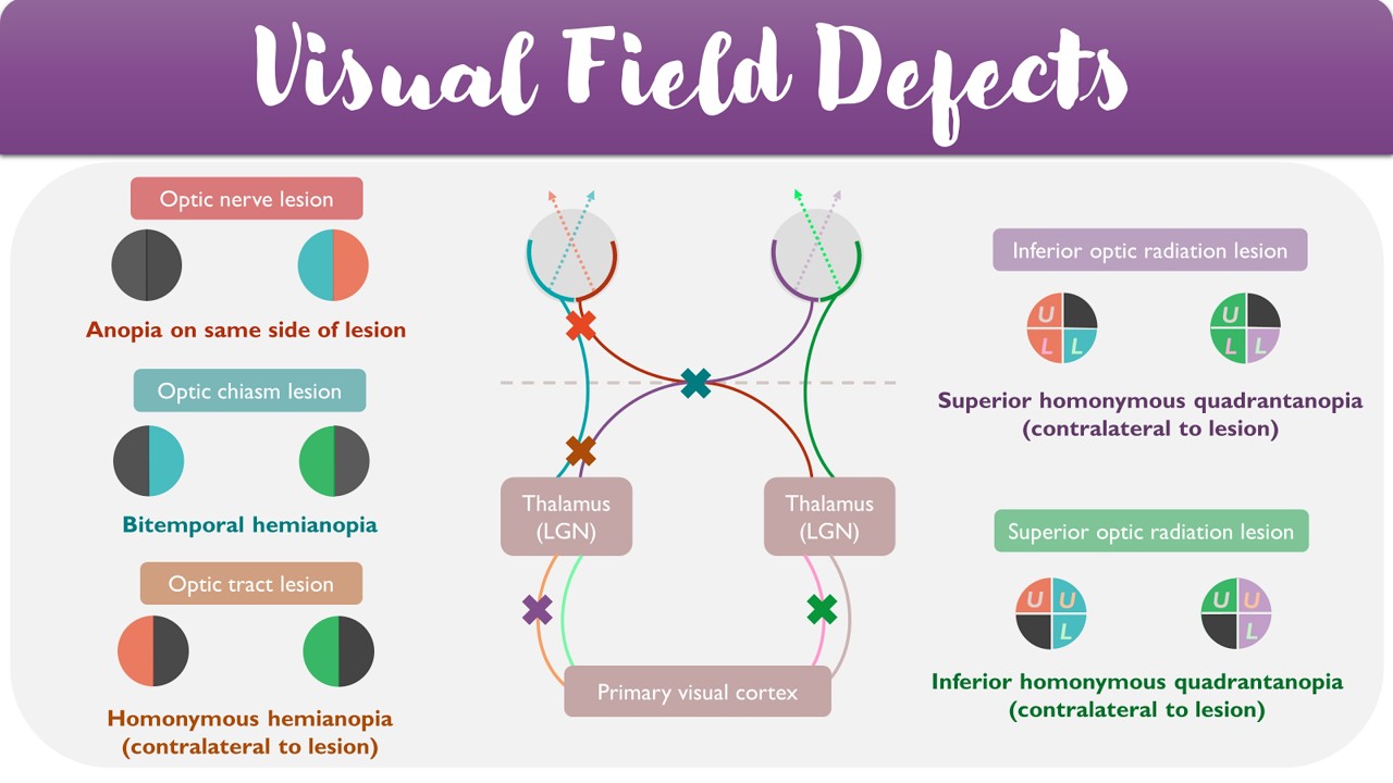 Visual Field Defects Explained | Visual Pathways