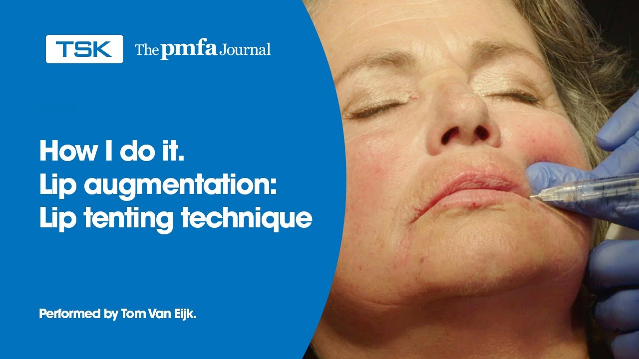 Lip augmentation: Lip Tenting Technique by Tom van Eijk