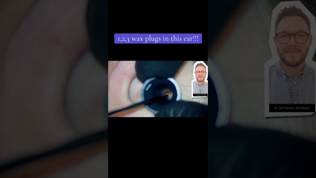 THREE wax lumps removed from this ear #earwaxremoval #microsuction #audiology