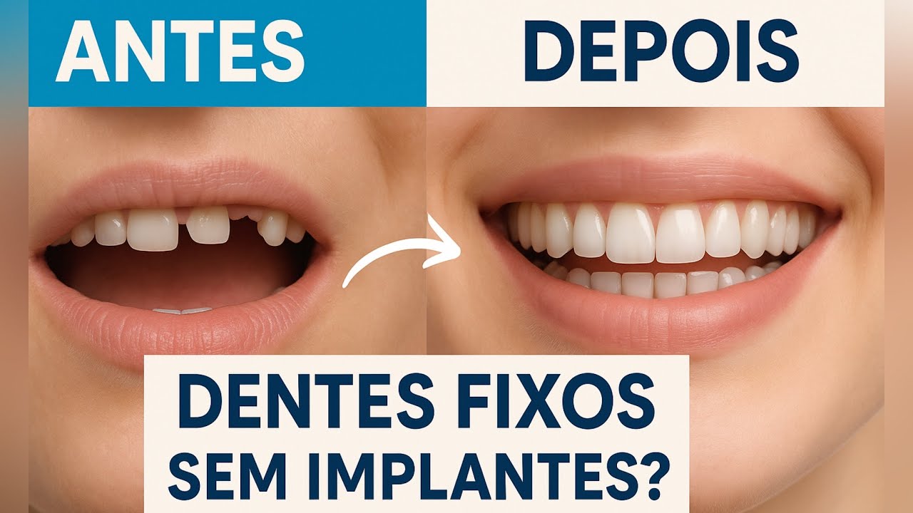 Como ter dentes fixos SEM implantes e em APENAS 1 dia! T&eacute;cnica r&aacute;pida e eficaz