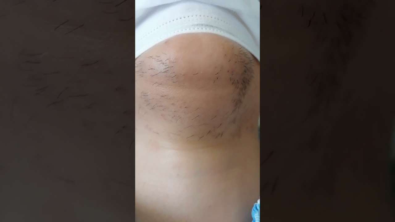 İğneli Epilasyon Amerikan Güzellik Salonu Gaziantep Tel:05539578735 #lazer #iğneliepilasyon