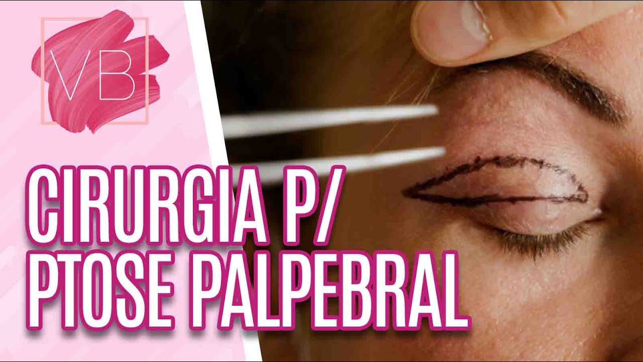 Cirurgia corrige ptose palpebral e excesso de pele nas pálpebras - Você Bonita (26/05/21)
