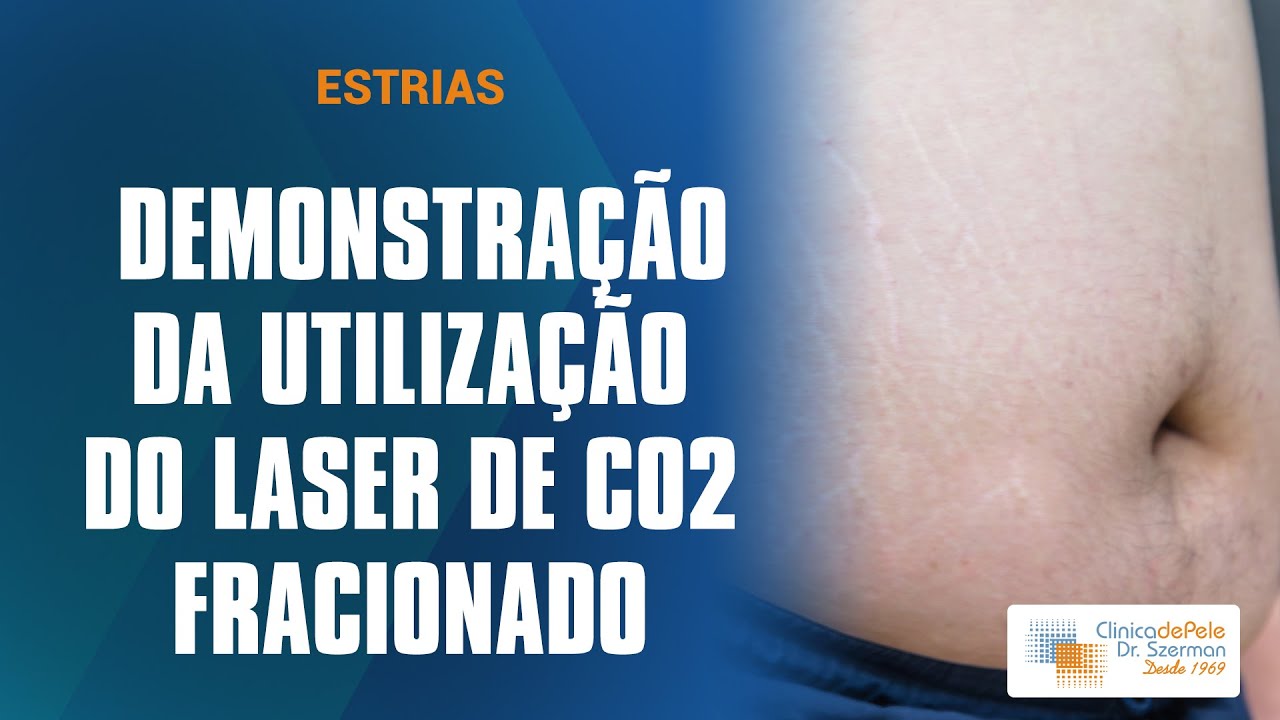 Estrias: Tratamento com Laser de CO2 Fracionado