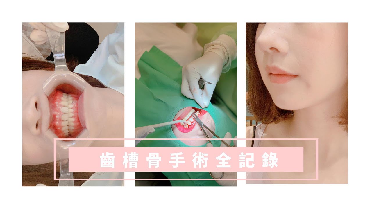牙套日記：齒槽骨手術全紀錄 膽小物進！｜OB歐蓓粒