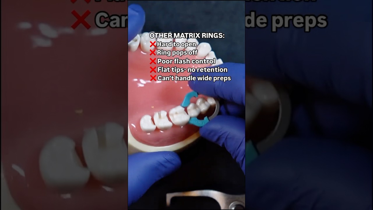 Still struggling with matrix rings that spring off in your patient&rsquo;s mouth? 😣 It&rsquo;s time to switch!