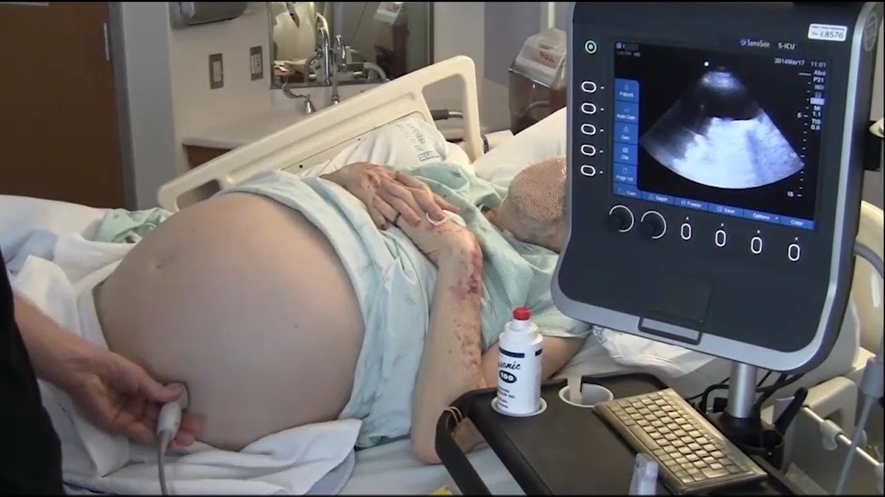 Ultrasound for Paracentesis -- BAVLS