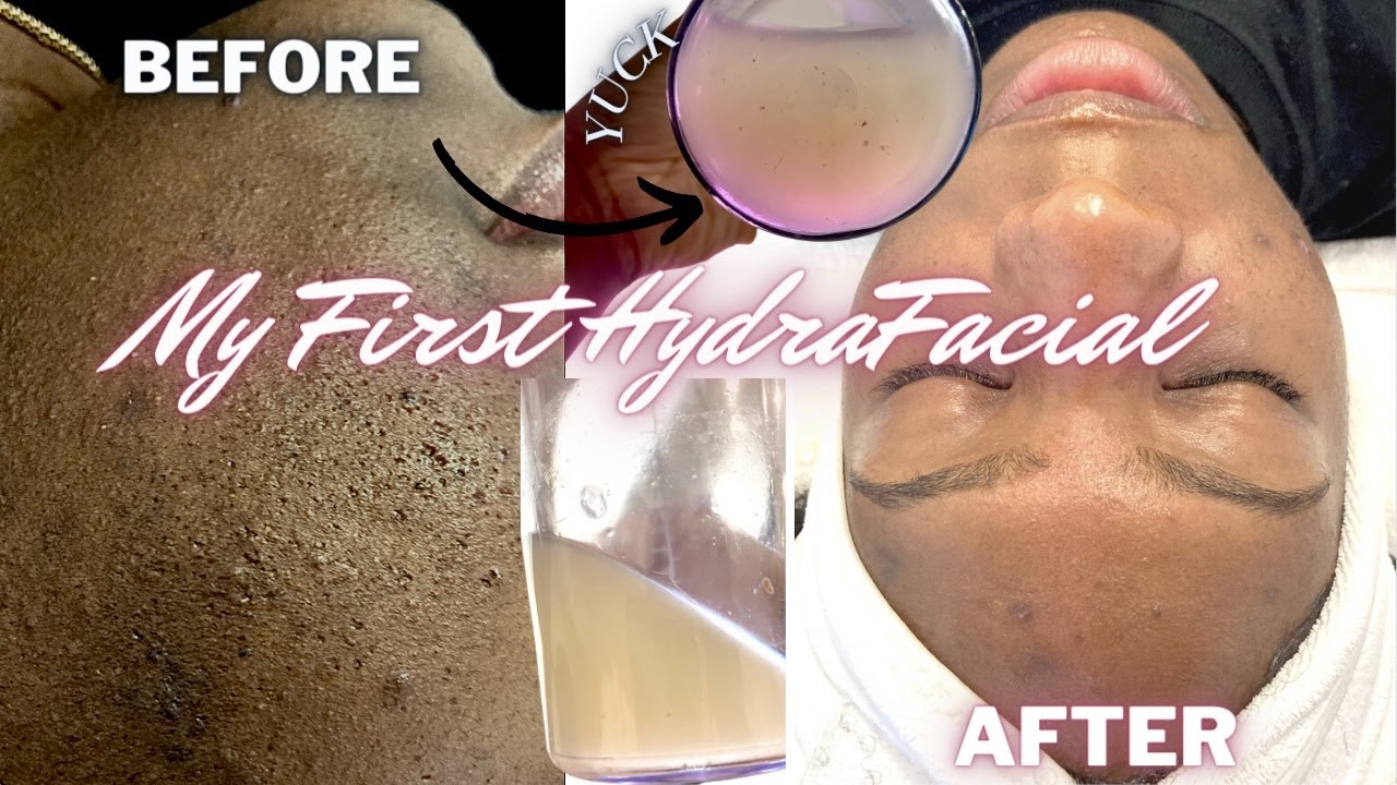 I CAN'T BELIEVE THAT CAME OUT MY SKIN! 😱😳 My FIRST HYDRAFACIAL | ACNE PRONE SKIN, EXTRACTIONS, LED |
