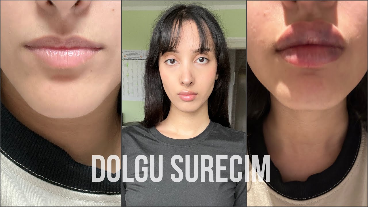 evlatliktan red edilecegim dudak dolgusu seruvenim