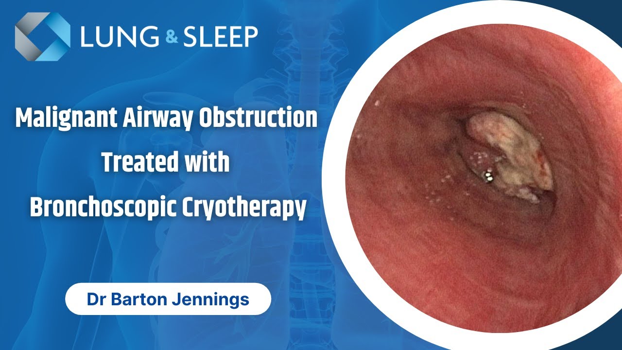Malignant airway obstruction treated with Bronchoscopic Cryotherapy